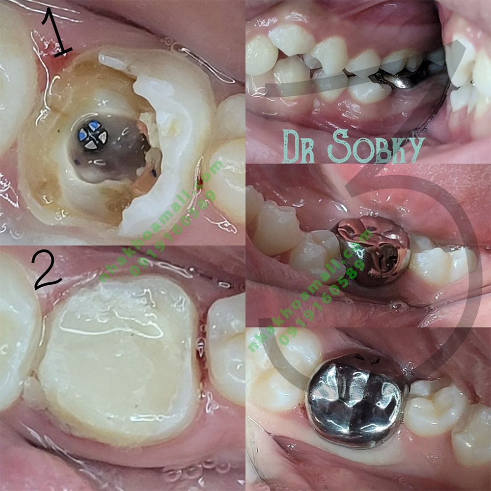 Hình ảnh lâm sàng cho 1 case  gãy ngang thân răng, gia cố ống tuỷ, tái tạo cùi bằng chốt Unimetric