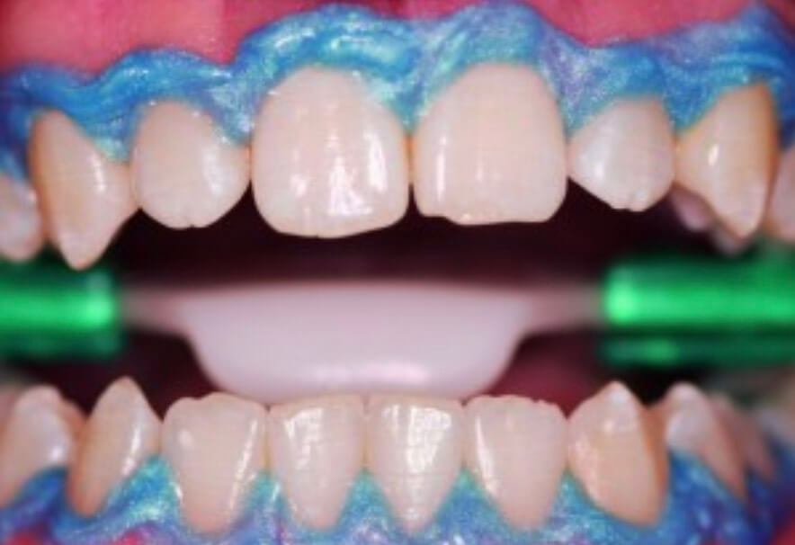 Tẩy trắng răng tại phòng Whiteness HP Maxx 35% - Bộ mini Kit sử dụng cho 2 bệnh nhân