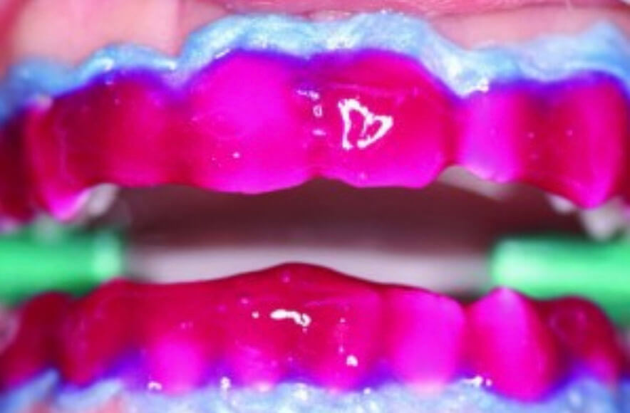 Tẩy trắng răng tại phòng Whiteness HP Maxx 35% - Bộ mini Kit sử dụng cho 2 bệnh nhân