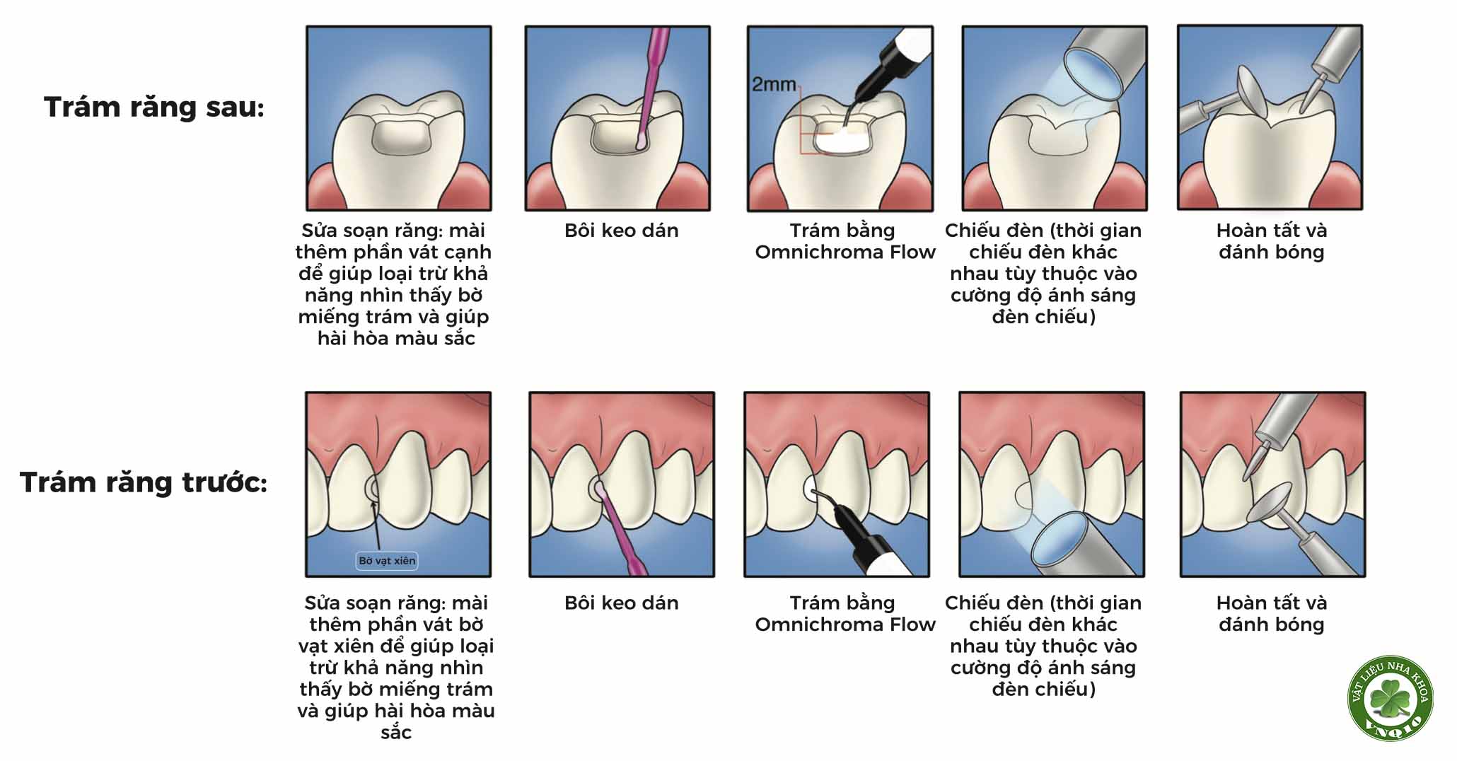 Composite lỏng trám răng đa năng Tokuyama Omnichroma Flow 