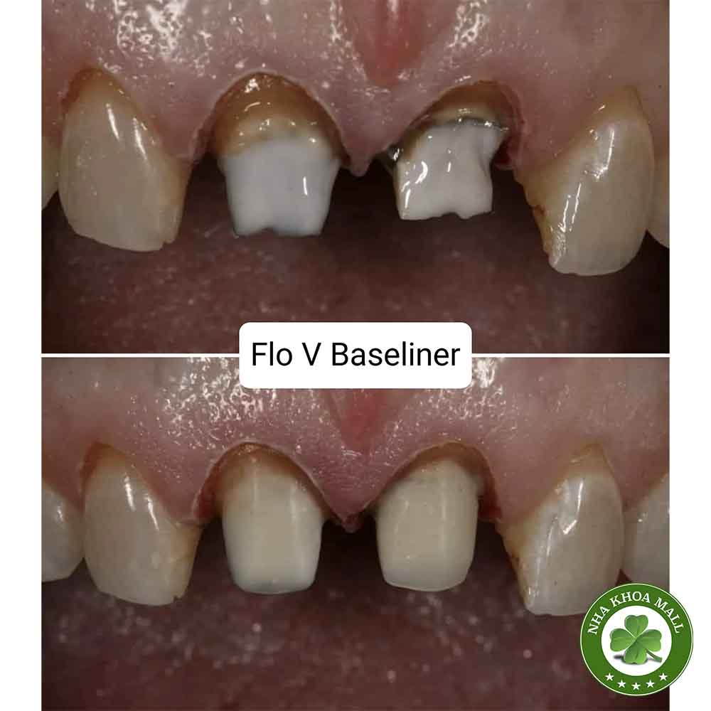 Composite lỏng trám răng Mani Flo-V