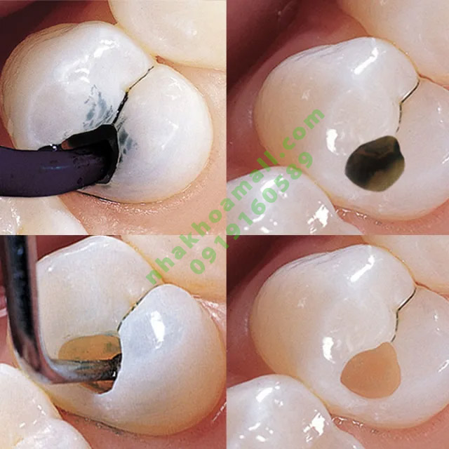 Vật liệu định vị ống tủy bị canxi hóa Sable Seek Caries Indicator Ultradent