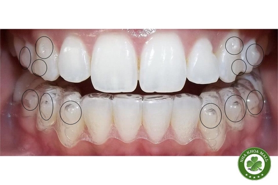 Vì sao attachment quyết định thành công trong điều trị bằng khay trong suốt?