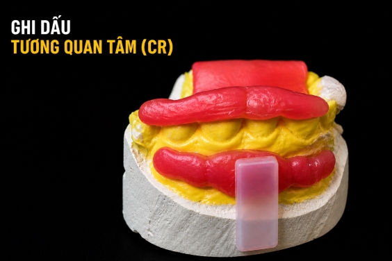 Ghi Dấu Tương Quan Tâm (CR) Chính Xác: Kỹ Thuật Lộ 1/2 Thân Răng Trên Sáp Cắn Và Ứng Dụng Lâm Sàng