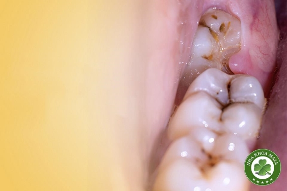 Giải Mã Những Bất Thường Khi Răng Khôn Phát Triển