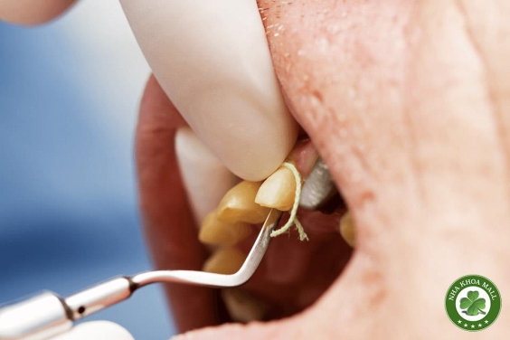 Kỹ thuật đặt chỉ co nướu: nguyên tắc, lựa chọn vật liệu và lưu ý lâm sàng