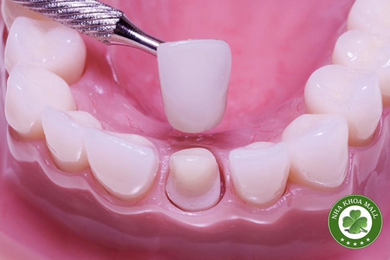 Bọc răng sứ được bao lâu - Câu trả lời KHÔNG PHẢI ai cũng biết 