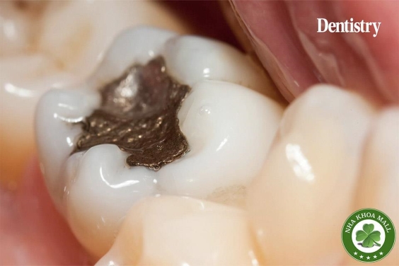 Trám răng bằng Amalgam có nguy hiểm không? 5 điều bạn cần biết trước khi quyết định