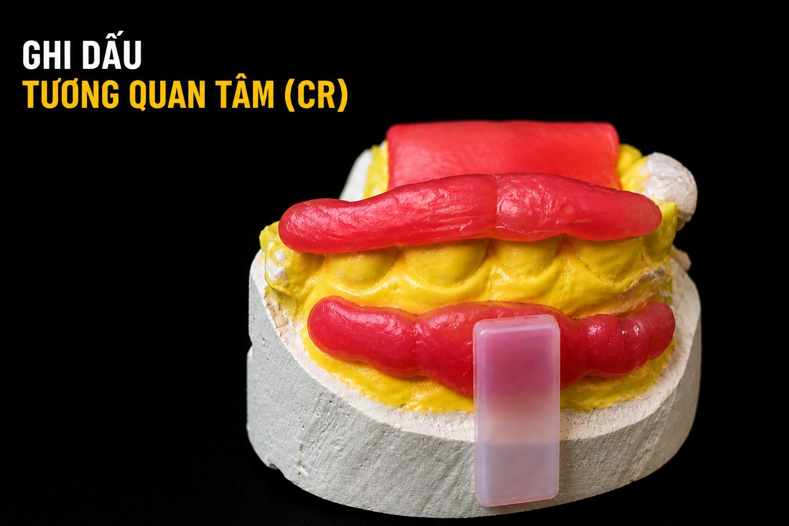 Ghi Dấu Tương Quan Tâm (CR) Chính Xác: Kỹ Thuật Lộ 1/2 Thân Răng Trên Sáp Cắn Và Ứng Dụng Lâm Sàng