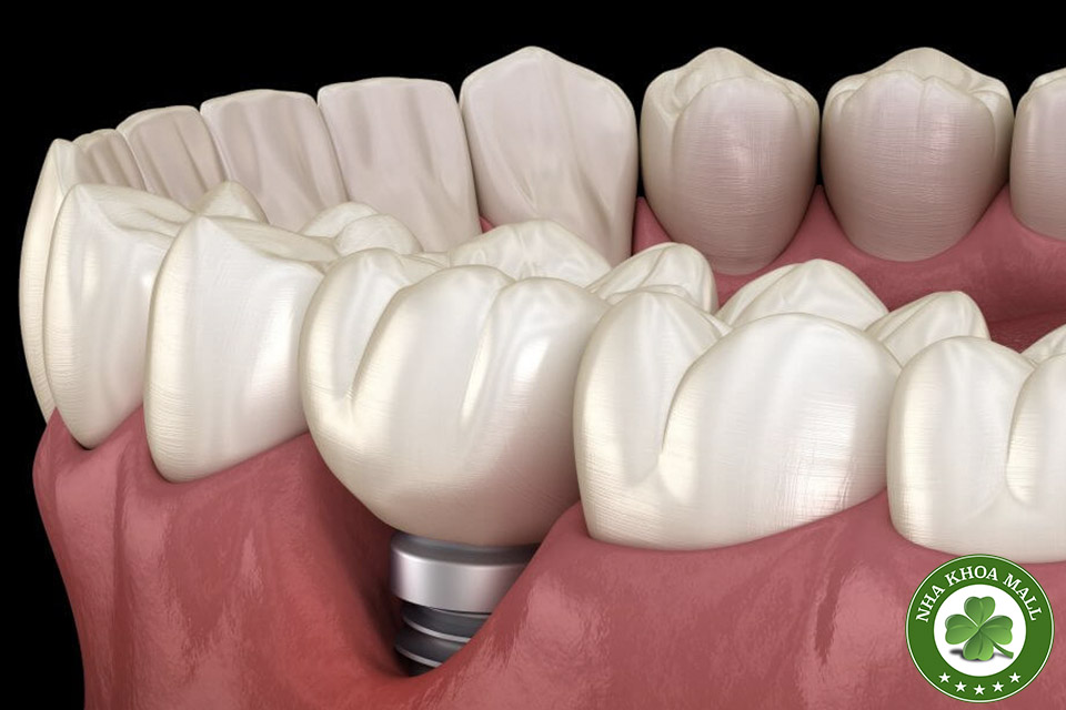 Răng cắm implant bị lung lay: Bí quyết xử lý nhanh chóng và hiệu quả