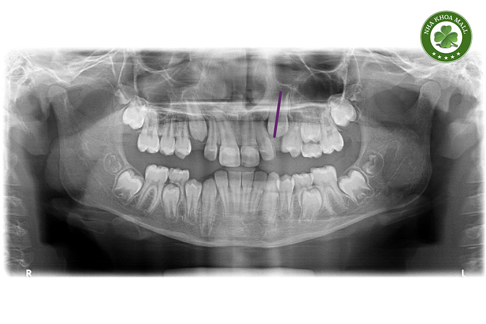 Răng nanh mọc ngầm có nhổ không? Tất cả những điều bạn cần biết