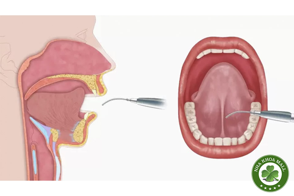 Cắt thắng lưỡi bằng laser: Phương pháp an toàn cho mọi lứa tuổi