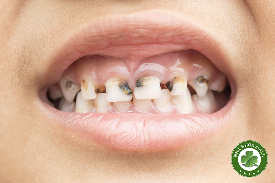 Sâu răng ở trẻ phải làm sao? Hành trang chăm sóc răng miệng cho con