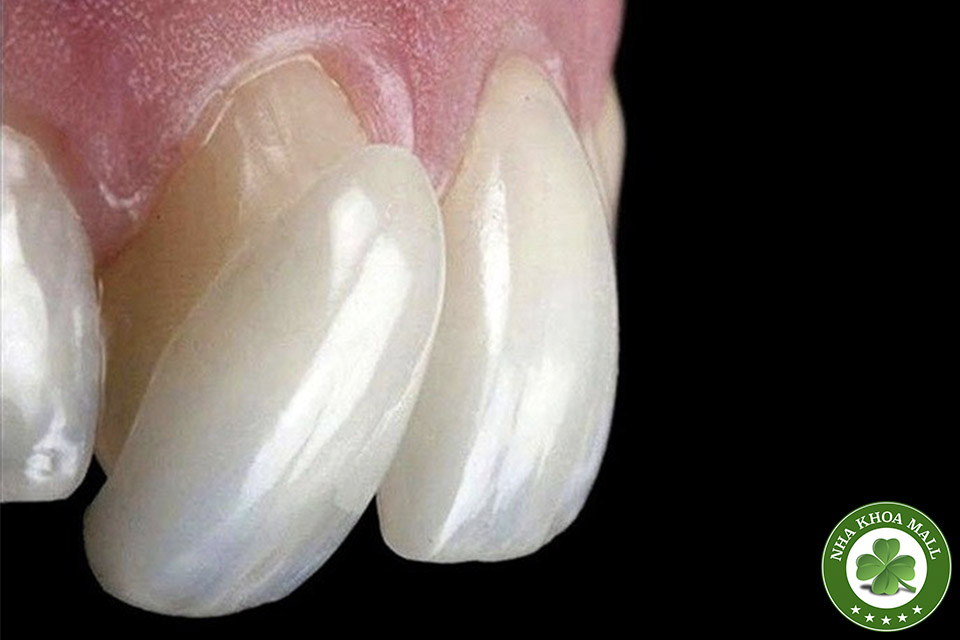 Kỹ thuật bọc răng sứ không mài là gì? Giải pháp thẩm mỹ nha khoa tiên tiến