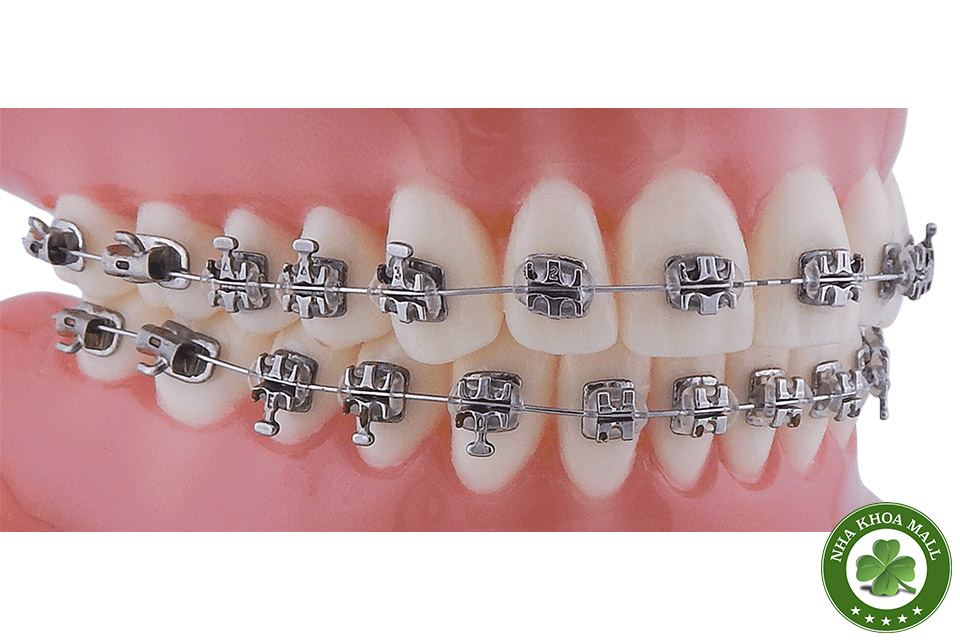 Mắc cài kim loại chỉnh nha RMO – Lựa chọn tối ưu cho nha sĩ hiện đại