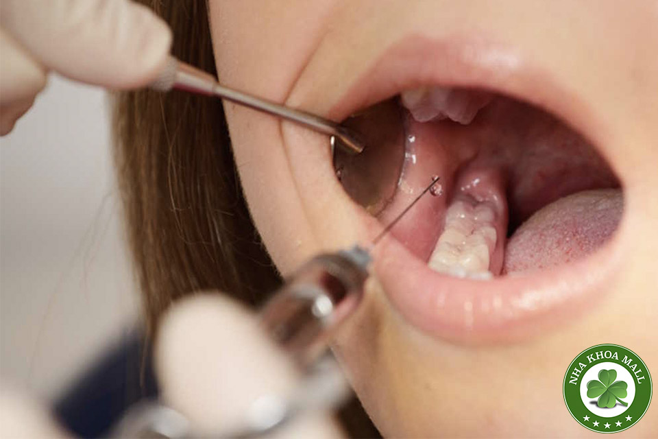 Các Vị Trí Chích Thuốc Tê Trong Nha Khoa: Hiểu Đúng, Làm Đúng