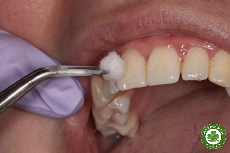 So Sánh Xịt Lạnh và Máy Thử Tủy: Lựa Chọn Hiệu Quả Trong Chẩn Đoán Tủy Răng