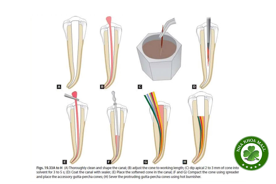 Một số lưu ý khi dùng Naocl 5,25% để khử khuẩn Cone gutta percha trước khi ốp