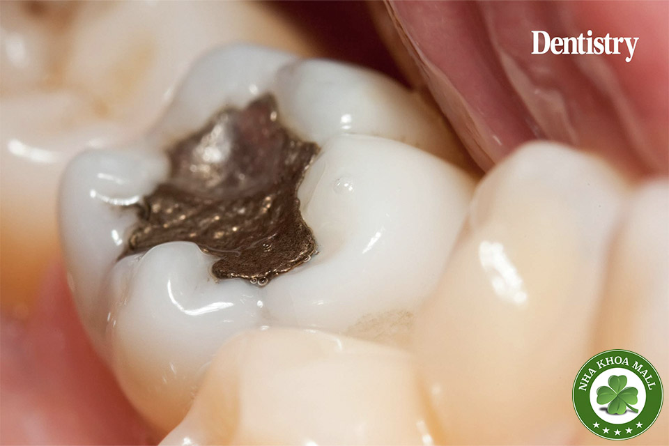 Trám răng bằng Amalgam có nguy hiểm không? 5 điều bạn cần biết trước khi quyết định