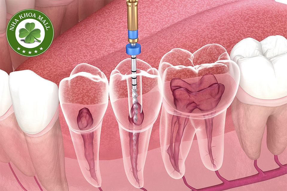 Điều Trị Tủy Răng: Quy Trình, Chuẩn Bị và Hiệu Quả