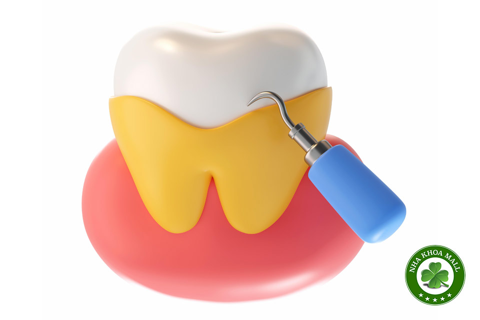 Đầu cạo vôi siêu âm bị mòn: nguyên nhân làm giảm hiệu quả điều trị 