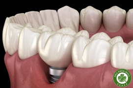 Răng cắm implant bị lung lay: Bí quyết xử lý nhanh chóng và hiệu quả