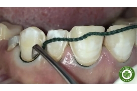 Chỉ co nướu SURE-Cord - Giải pháp tối ưu trong quản lý mô nướu trước lấy dấu và phục hình