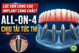 All-on-4 chịu tải tức thì: vì sao lực vặn cao chưa chắc đồng nghĩa với Implant ổn định?