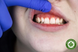 Viêm nướu răng: 5 Bước đơn giản để nói không với sưng đau