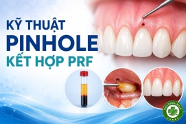 Kỹ thuật phẫu thuật Pinhole kết hợp fibrin giàu tiểu cầu (PRF) nhằm tăng cường ghép mô mềm