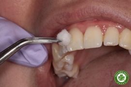 So Sánh Xịt Lạnh và Máy Thử Tủy: Lựa Chọn Hiệu Quả Trong Chẩn Đoán Tủy Răng