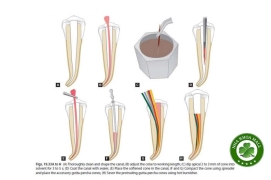 Một số lưu ý khi dùng Naocl 5,25% để khử khuẩn Cone gutta percha trước khi ốp