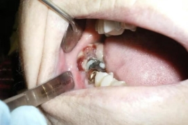 Case lâm sàng bệnh lý miệng với tiền sử y khoa phức tạp
