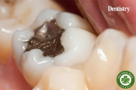 Trám răng bằng Amalgam có nguy hiểm không? 5 điều bạn cần biết trước khi quyết định