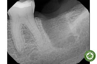 Những ảnh hưởng lâm sàng của ổ chân răng còn sót lại sau khi nhổ răng