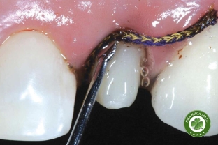 ViscoStat Clear – Giải pháp kiểm soát chảy máu và dịch nướu hiệu quả trong nha khoa phục hình