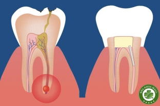 Điều trị tủy có đau không? Mẹo để tránh phải điều trị tủy