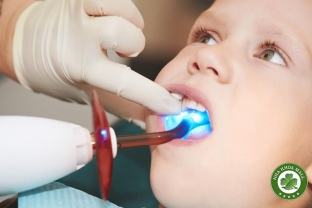 Trám bít sealants ngăn ngừa sâu răng ở trẻ em và bảo vệ sức khỏe răng miệng của trẻ