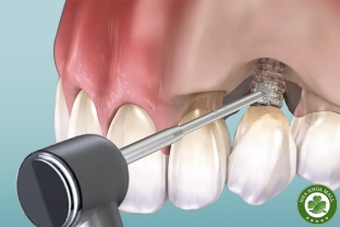 Vệ sinh kém – Nguyên nhân hàng đầu khiến implant thất bại