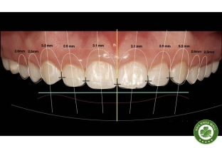 Xác định vị trí đường viền nướu trong thiết kế nụ cười nha khoa