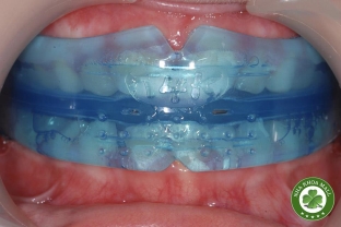 Hàm Trainer T4K – Bí quyết chỉnh nha sớm giúp trẻ tự tin và khỏe mạnh