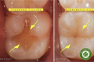 Xi măng trám răng: Khám phá bí quyết giúp tăng độ bền, bảo vệ răng tối ưu