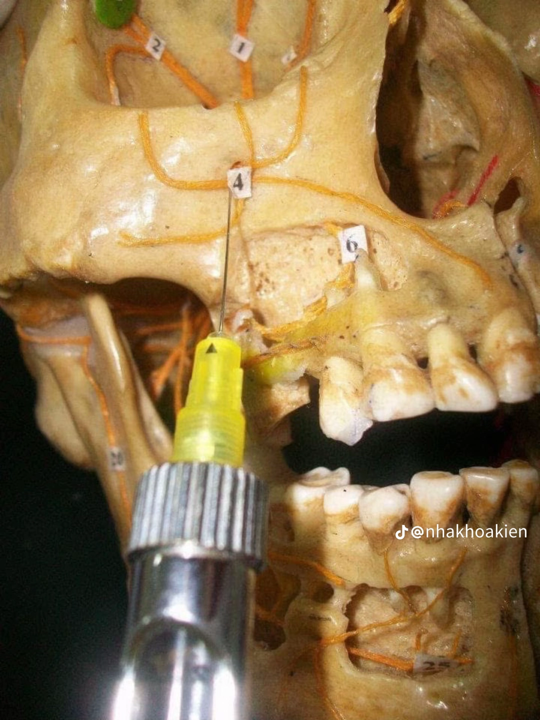 Vị trí 1