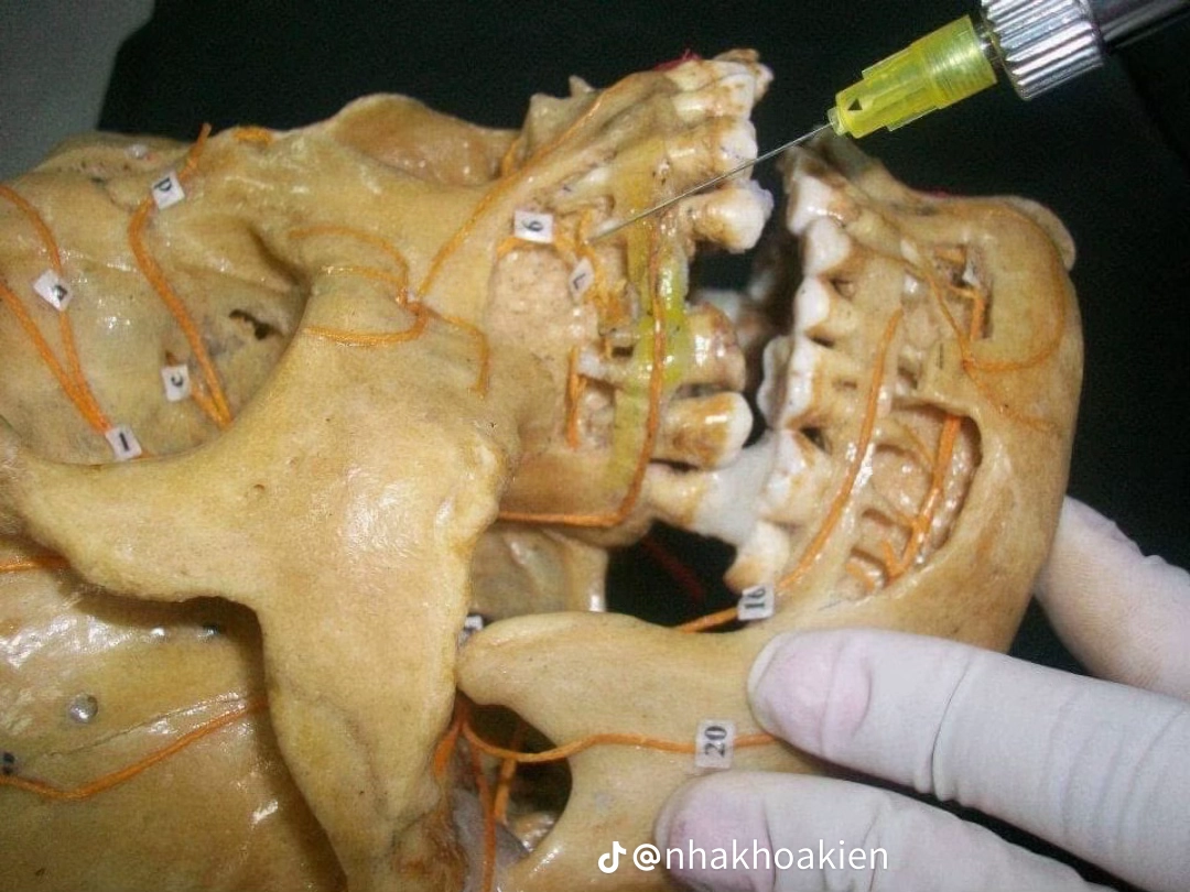 Vị trí 17