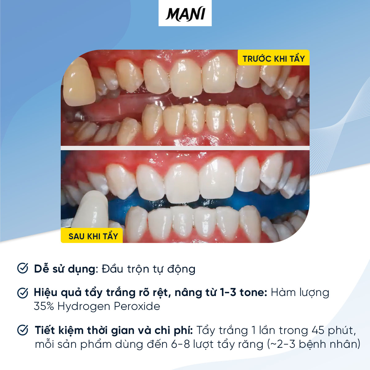 Tẩy trắng răng tại phòng Mani Bleach n Shine One Patient Kit - Bộ