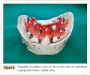 Vật liệu lấy dấu phục hình all on 4 - Nhựa tự cứng làm khóa chuyển implant - PATTERN RESIN GC