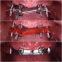 Vật liệu lấy dấu phục hình all on 4 - Nhựa tự cứng làm khóa chuyển implant - PATTERN RESIN GC