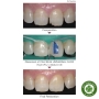 Composite lỏng PALFIQUE UNIVERSAL FLOW Medium Tokuyama