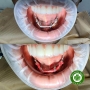 Vật liệu làm khóa chuyển implant dạng tuýp trộn sẵn Pattern Resin LHKDent