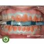 Banh miệng sử dụng kèm với tẩy trắng răng tại phòng Opalescence Boost